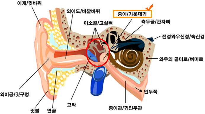 소아 급성 중이염